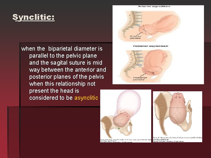 Synclitic: when the biparietal diameter is parallel to the pelvic plane and the sagital