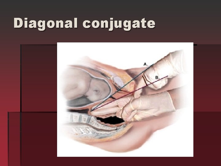 Diagonal conjugate 