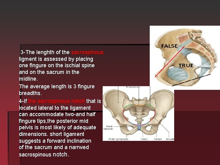3 -The lenghth of the sacrospinous ligment is assessed by placing one fingure on 3 -The lenghth of the sacrospinous ligment is assessed by placing one fingure on