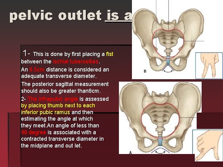 pelvic outlet is assessed. 1 - This is done by first placing a fist