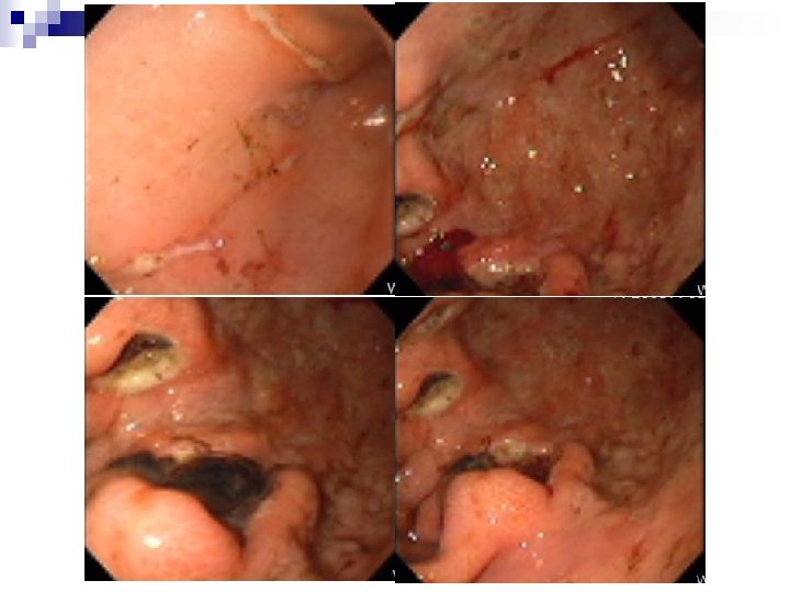 Initial gastroscopy Initial gastroscopy