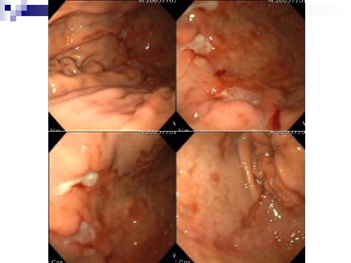 F/U gastroscopy (5일 후) F/U gastroscopy (5일 후)