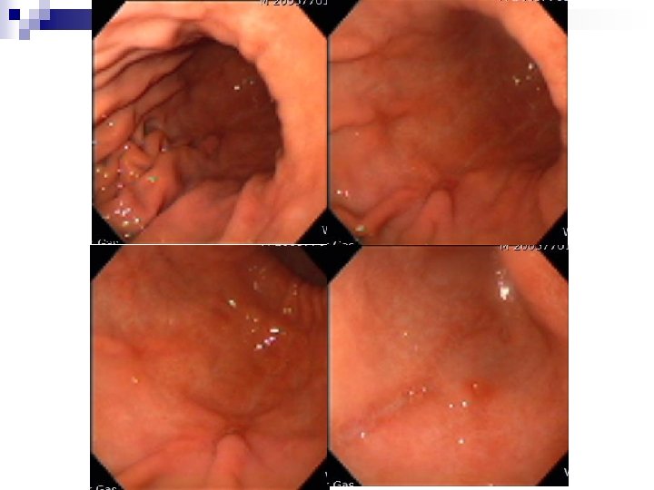 F/U gastroscopy (Post PDL 14 days ) F/U gastroscopy (Post PDL 14 days )