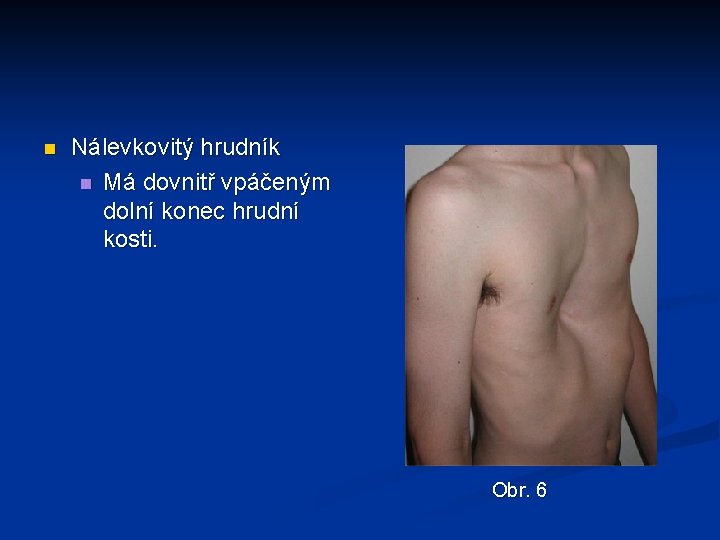 n Nálevkovitý hrudník n Má dovnitř vpáčeným dolní konec hrudní kosti. Obr. 6 n Nálevkovitý hrudník n Má dovnitř vpáčeným dolní konec hrudní kosti. Obr. 6
