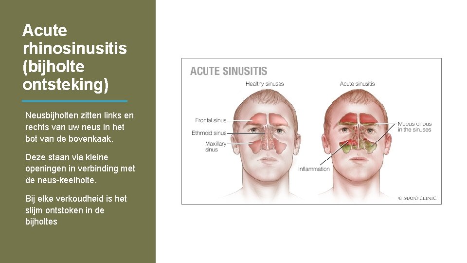 Acute rhinosinusitis (bijholte ontsteking) Neusbijholten zitten links en rechts van uw neus in het
