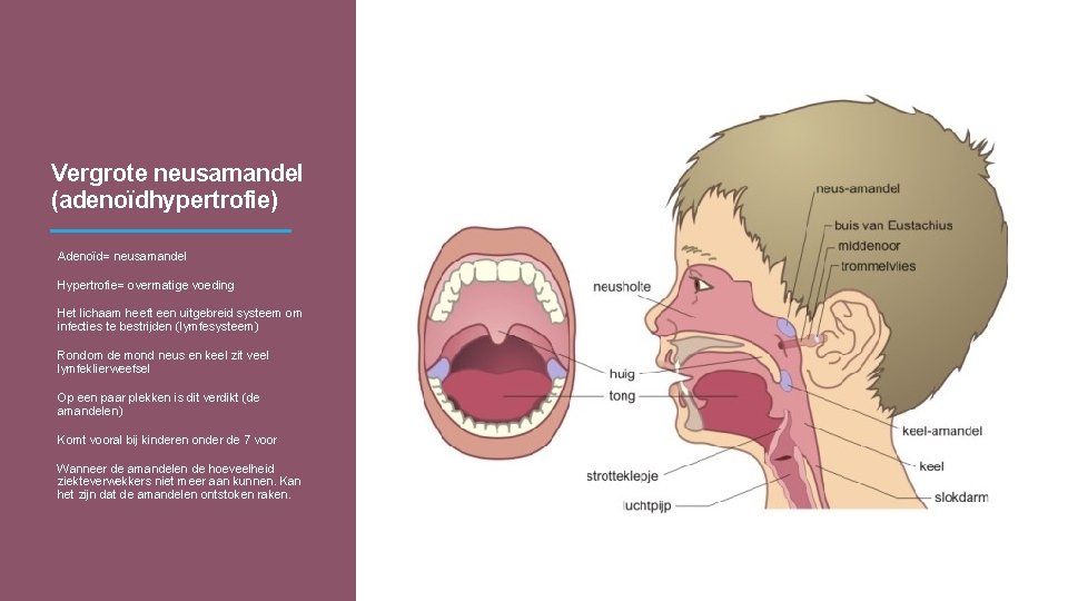 Vergrote neusamandel (adenoïdhypertrofie) Adenoïd= neusamandel Hypertrofie= overmatige voeding Het lichaam heeft een uitgebreid systeem