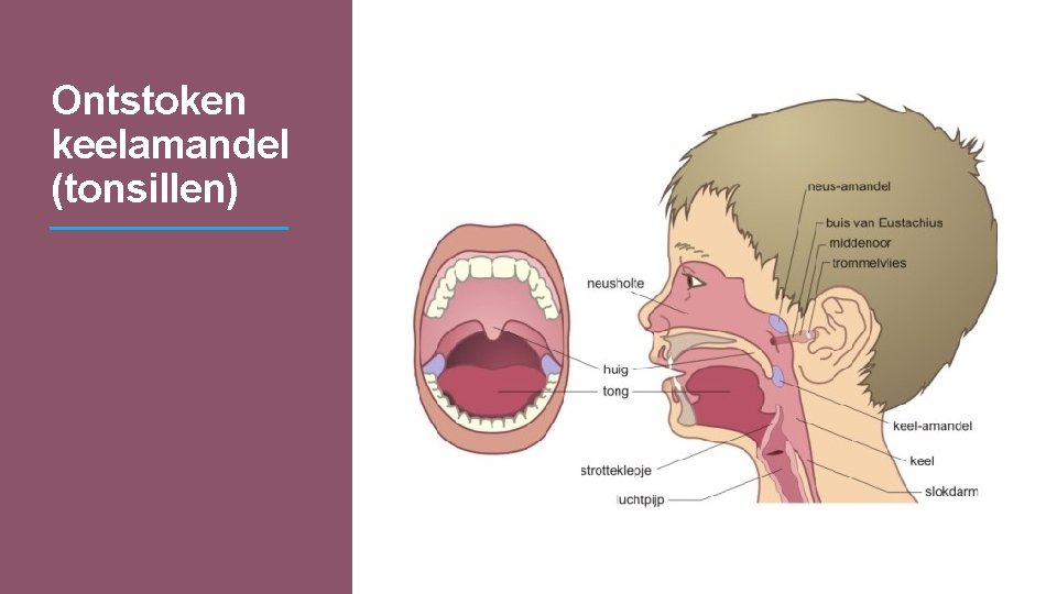 Ontstoken keelamandel (tonsillen) 
