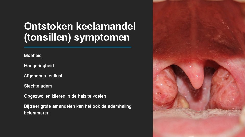 Ontstoken keelamandel (tonsillen) symptomen Moeheid Hangeringheid Afgenomen eetlust Slechte adem Opgezwollen klieren in de