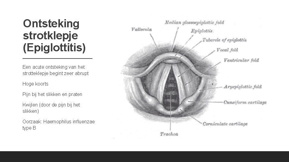 Ontsteking strotklepje (Epiglottitis) Een acute ontsteking van het strotteklepje begint zeer abrupt Hoge koorts