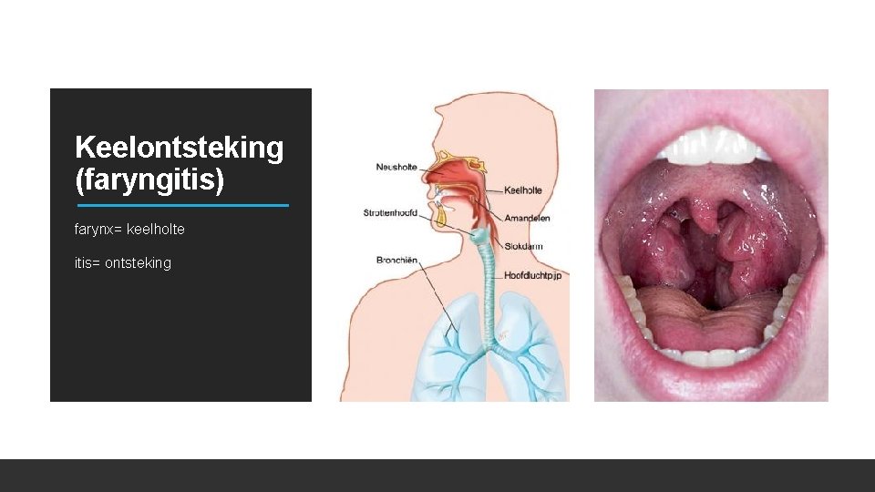 Keelontsteking (faryngitis) farynx= keelholte itis= ontsteking 