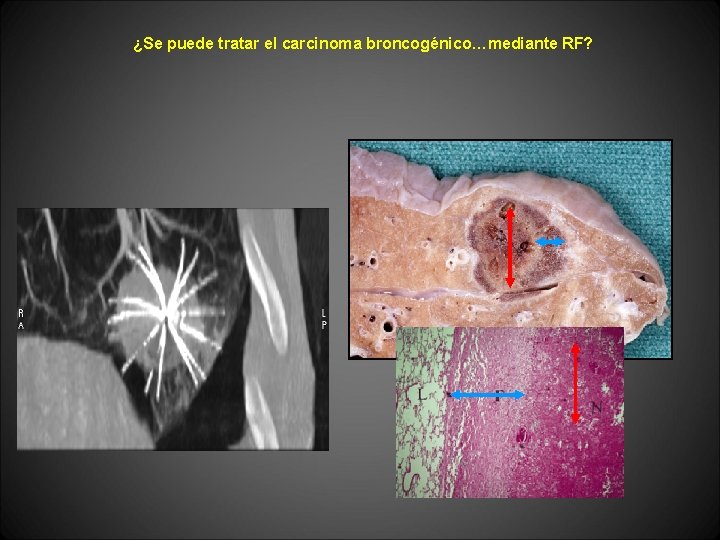 ¿Se puede tratar el carcinoma broncogénico…mediante RF? 