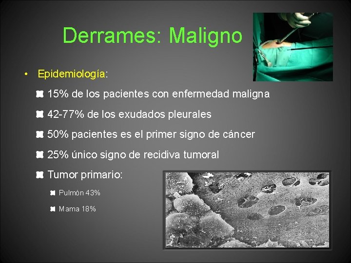 Derrames: Maligno • Epidemiología: 15% de los pacientes con enfermedad maligna 42 -77% de