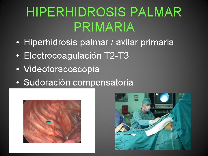 HIPERHIDROSIS PALMAR PRIMARIA • • Hiperhidrosis palmar / axilar primaria Electrocoagulación T 2 -T