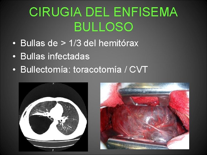 CIRUGIA DEL ENFISEMA BULLOSO • Bullas de > 1/3 del hemitórax • Bullas infectadas