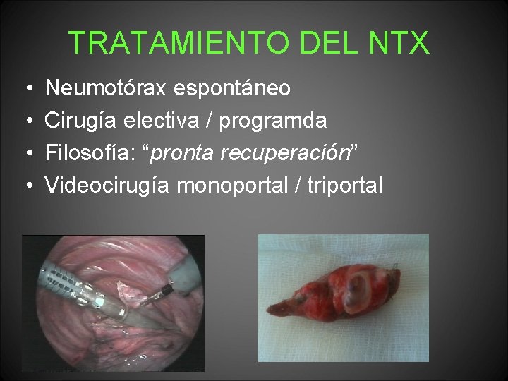 TRATAMIENTO DEL NTX • • Neumotórax espontáneo Cirugía electiva / programda Filosofía: “pronta recuperación”