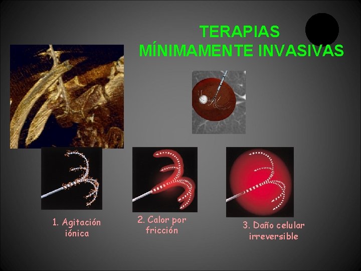 TERAPIAS MÍNIMAMENTE INVASIVAS 1. Agitación iónica 2. Calor por fricción 3. Daño celular irreversible