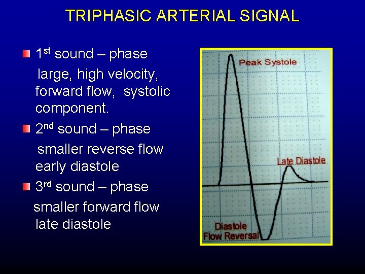 TRIPHASIC ARTERIAL SIGNAL 1 st sound – phase large, high velocity, forward flow, systolic