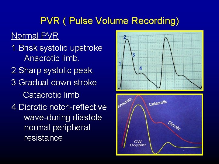 PVR ( Pulse Volume Recording) Normal PVR 1. Brisk systolic upstroke Anacrotic limb. 2.