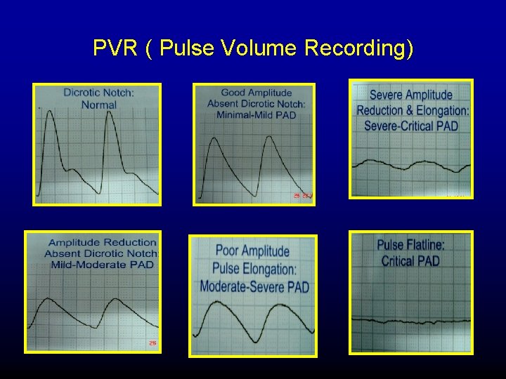 PVR ( Pulse Volume Recording) 