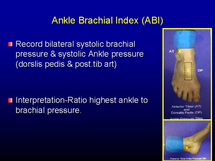 Ankle Brachial Index (ABI) Record bilateral systolic brachial pressure & systolic Ankle pressure (dorslis