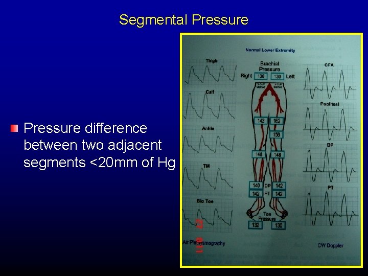 Segmental Pressure difference between two adjacent segments <20 mm of Hg 