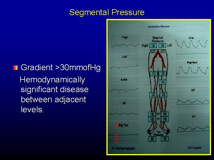 Segmental Pressure Gradient >30 mmof. Hg Hemodynamically significant disease between adjacent levels. 