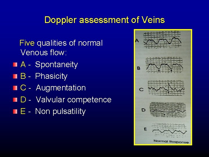Doppler assessment of Veins Five qualities of normal Venous flow: A - Spontaneity B