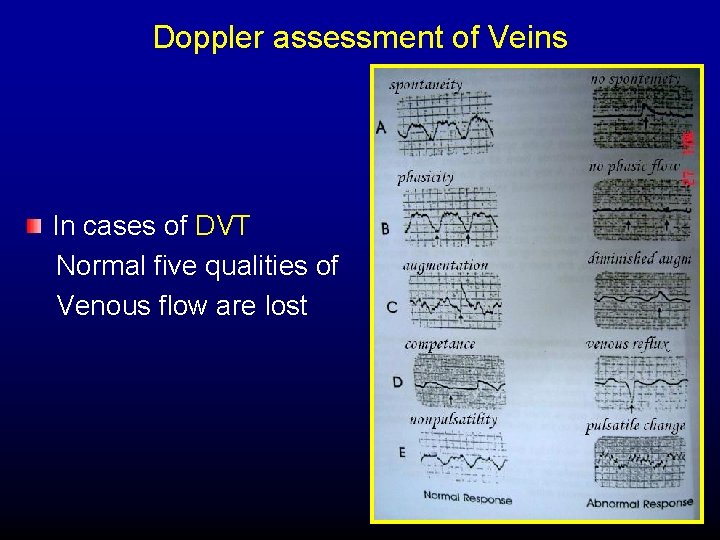 Doppler assessment of Veins In cases of DVT Normal five qualities of Venous flow
