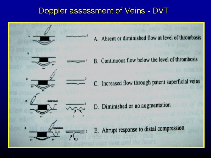 Doppler assessment of Veins - DVT 
