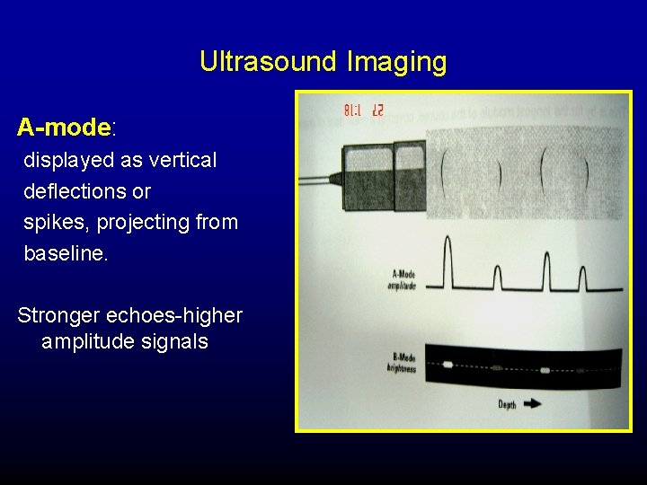 Ultrasound Imaging A-mode: displayed as vertical deflections or spikes, projecting from baseline. Stronger echoes-higher