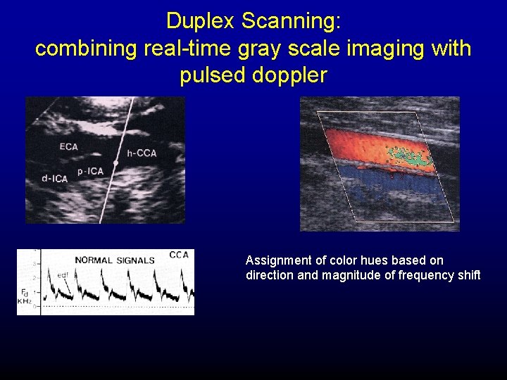 Duplex Scanning: combining real-time gray scale imaging with pulsed doppler Assignment of color hues
