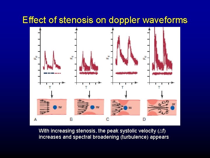 Effect of stenosis on doppler waveforms With increasing stenosis, the peak systolic velocity (Df)