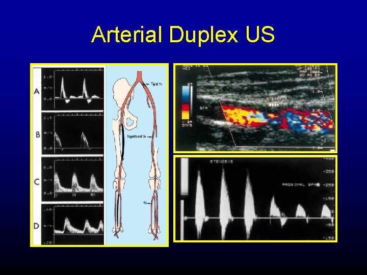 Arterial Duplex US 