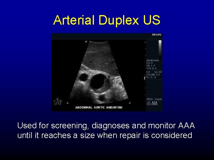 Arterial Duplex US Used for screening, diagnoses and monitor AAA until it reaches a