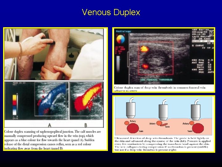 Venous Duplex 