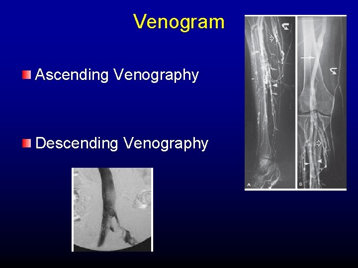 Venogram Ascending Venography Descending Venography 