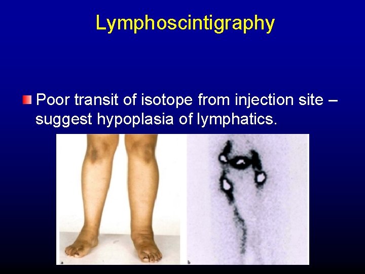Lymphoscintigraphy Poor transit of isotope from injection site – suggest hypoplasia of lymphatics. 