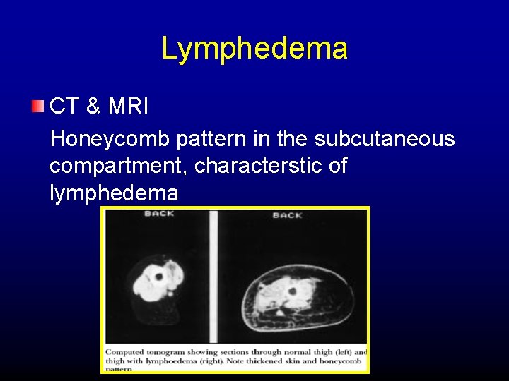 Lymphedema CT & MRI Honeycomb pattern in the subcutaneous compartment, characterstic of lymphedema 