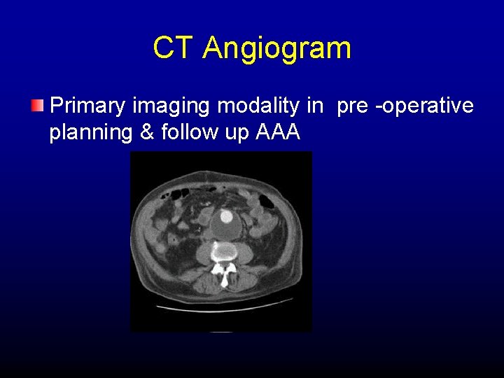 CT Angiogram Primary imaging modality in pre -operative planning & follow up AAA 