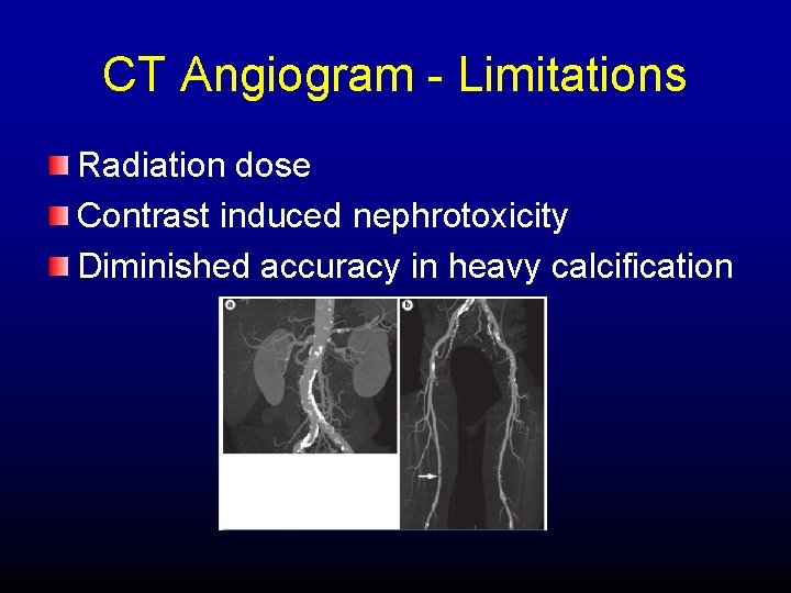 CT Angiogram - Limitations Radiation dose Contrast induced nephrotoxicity Diminished accuracy in heavy calcification