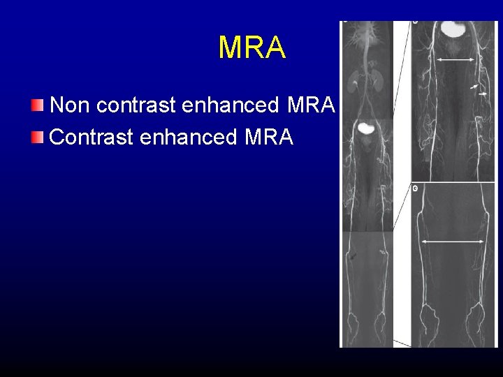 MRA Non contrast enhanced MRA Contrast enhanced MRA 