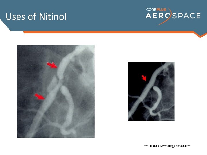 Uses of Nitinol Hall-Garcia Cardiology Associates 