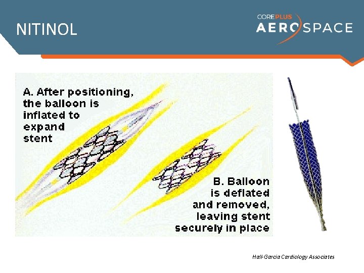 NITINOL Hall-Garcia Cardiology Associates 