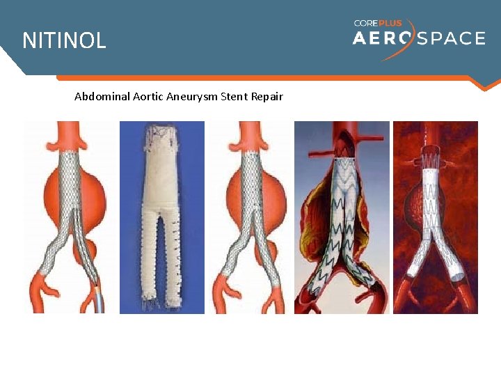 NITINOL Abdominal Aortic Aneurysm Stent Repair 