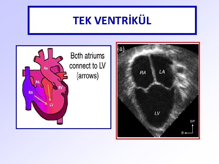 TEK VENTRİKÜL 