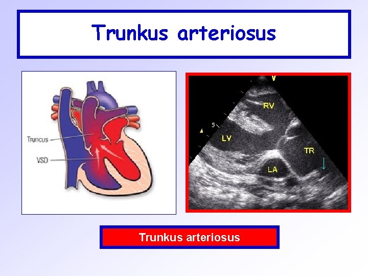 Trunkus arteriosus 