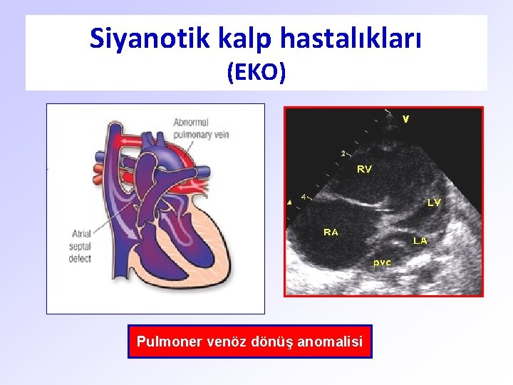 Siyanotik kalp hastalıkları (EKO) Pulmoner venöz dönüş anomalisi 