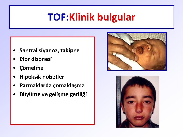 TOF: Klinik bulgular • • • Santral siyanoz, takipne Efor dispnesi Çömelme Hipoksik nöbetler