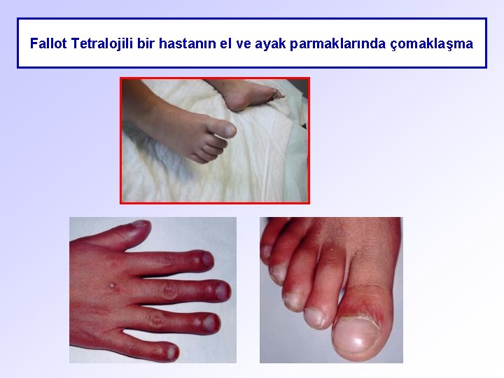 Fallot Tetralojili bir hastanın el ve ayak parmaklarında çomaklaşma 