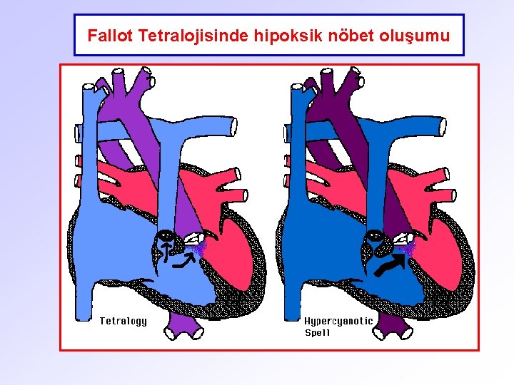 Fallot Tetralojisinde hipoksik nöbet oluşumu 